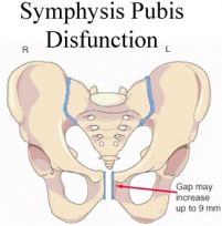 Symphysis Pubis Dysfunction 2